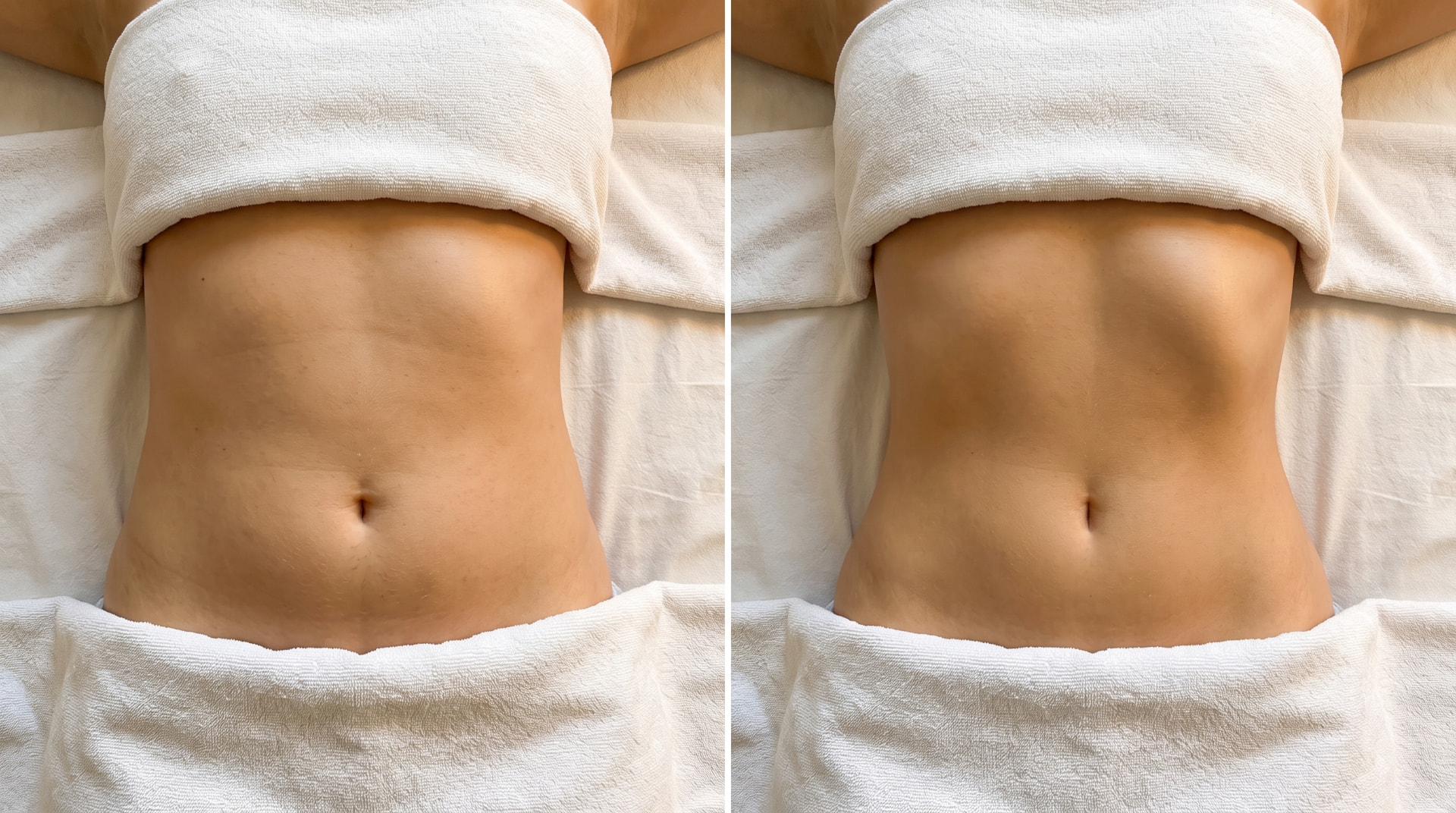 Body contouring before and after treatment